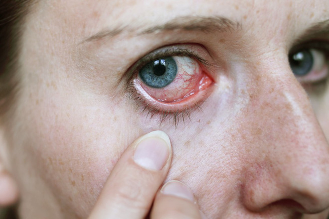 Nhận biết các bệnh dễ mắc qua những triệu chứng bất thường ở đôi mắt - Ảnh 3