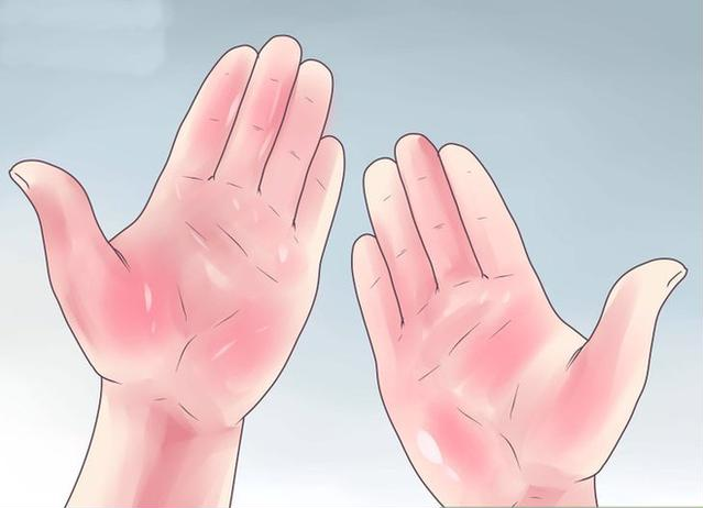 Nếu thấy bàn tay xuất hiện những dấu hiệu bất thường này, đến gặp bác sĩ ngay kẻo không kịp - Ảnh 4