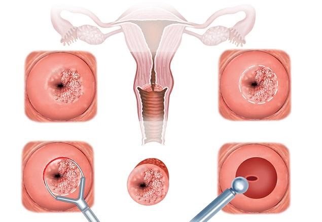 Viêm lộ tuyến cổ tử cung là gì, dấu hiệu và cách phòng tránh hiệu quả - Ảnh 1