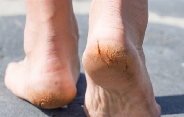 Những dấu hiệu ở bàn chân dễ cảnh báo cơ thể mang “trọng bệnh” - Ảnh 1