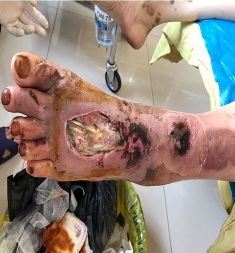 Mới 28 tuổi, thanh niên Phú Thọ phải cắt cụt chân vì đắp lá chữa vết thương - Ảnh 1
