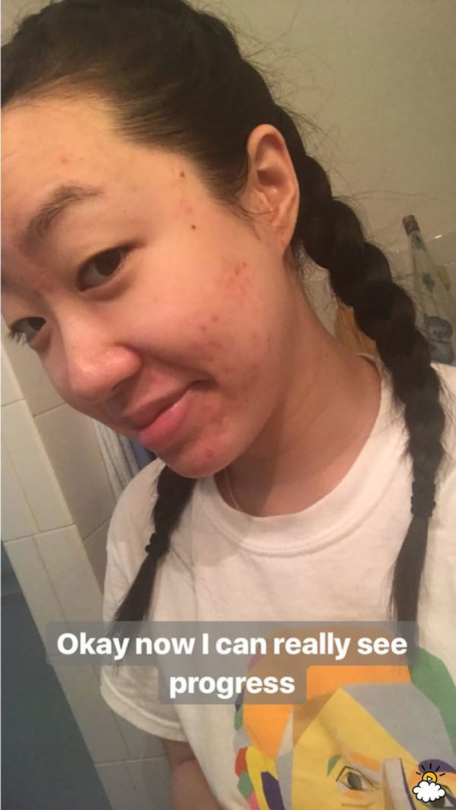Thoa dầu dừa lên da trong 1 tuần để chữa sẹo mụn, cô nàng này đã nhận được kết quả đáng thất vọng - Ảnh 6