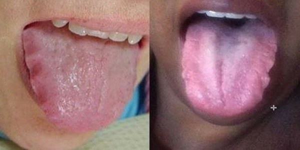Nhìn lưỡi đoán bệnh: Cách chẩn đoán chính xác đến không ngờ - Ảnh 3