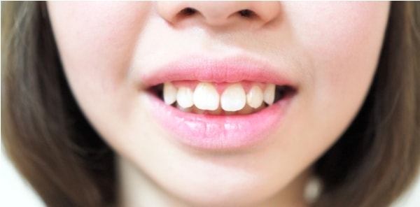 Răng hô, móm gây ảnh hưởng đến tính thẩm mỹ và tác động xấu đến chức năng ăn, nhai