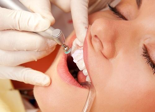 Mài răng hô là phương pháp chữa răng hô hiệu quả nhanh