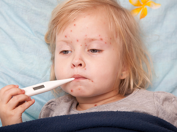 Bệnh có biểu hiện là trẻ sốt và phát ban