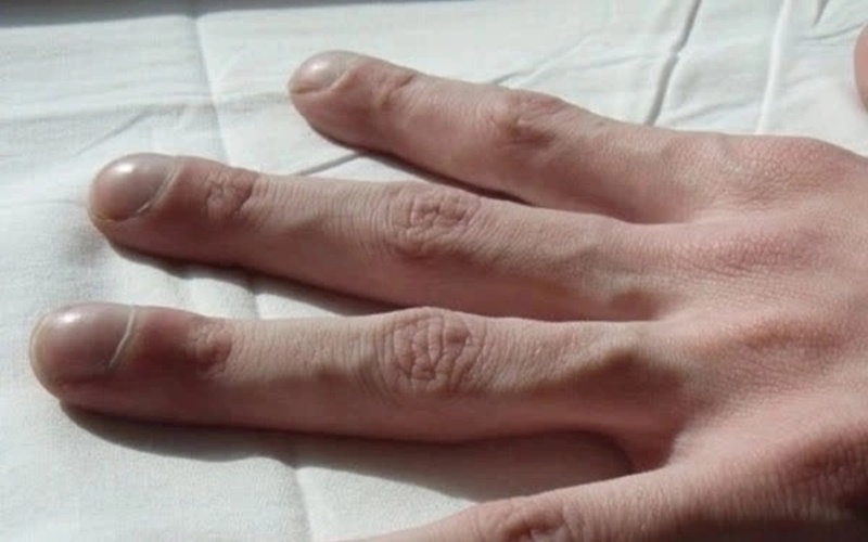 Phát hiện 3 dấu hiệu dị thường ở ngón tay chứng tỏ ung thư: kiêng những thực phẩm tàn phá cơ thể từng giây này là vừa - Ảnh 2