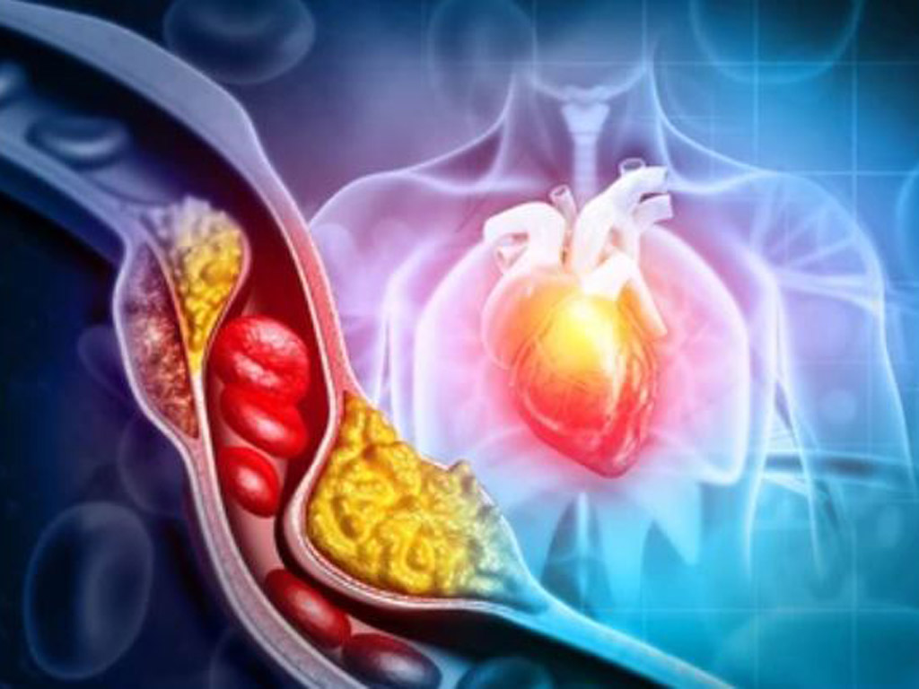 Cholesterol cao có di truyền không? Gặp những dấu hiệu này đi khám ngay trước khi tim kêu cứu - Ảnh 2