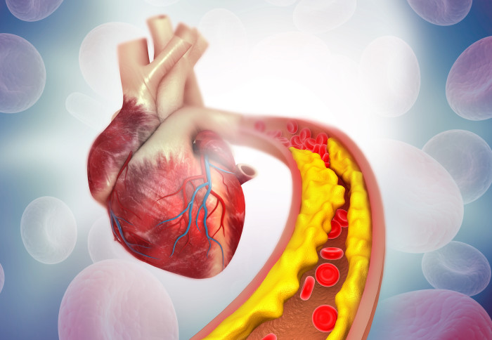 Cholesterol cao có di truyền không? Gặp những dấu hiệu này đi khám ngay trước khi tim kêu cứu - Ảnh 4