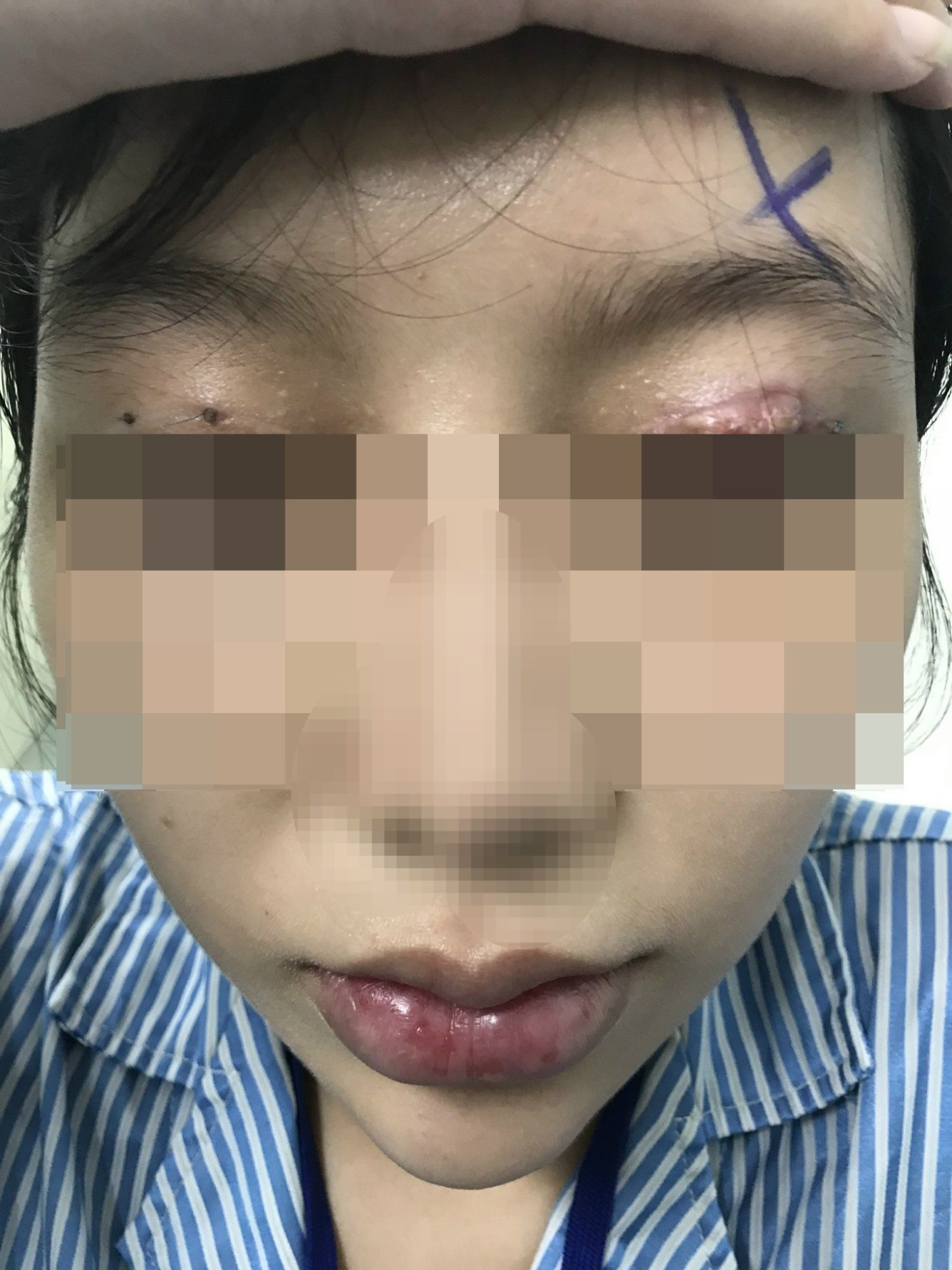TP.HCM: Chi tiền triệu cắt mí mắt ở cơ sở thẩm mỹ 'chui', một phụ nữ bị thủng 4 lỗ ở mắt - Ảnh 1