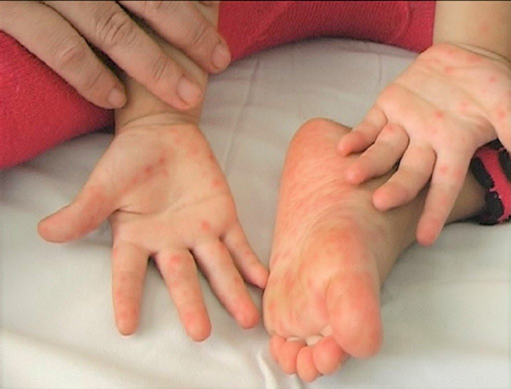 Virus chân tay miệng nặng ở trẻ em tái xuất, TP.HCM cảnh báo khẩn - Ảnh 2