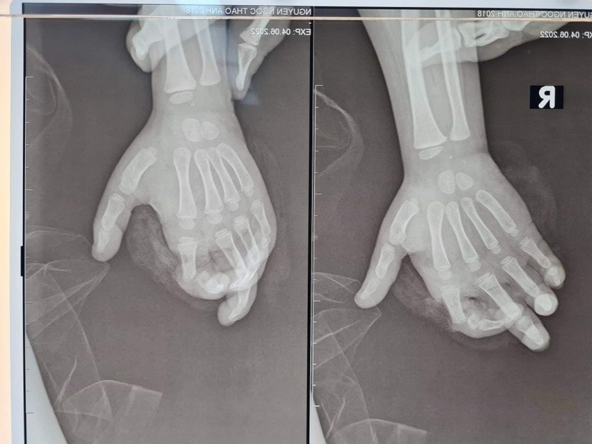 Không để ý máy sinh tố đang xay, bé gái ở Hà Nội bị nghiền nát 2 ngón tay - Ảnh 1
