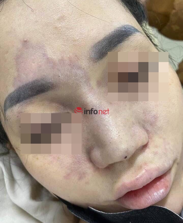 Đà Nẵng: Cô gái trẻ bị mù mắt phải sau khi tiêm filler nâng mũi ở spa - Ảnh 1