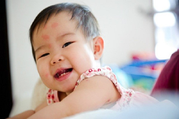 Bác sĩ Nhi hướng dẫn cha mẹ cách trị vết muỗi đốt đơn giản cho trẻ em  - Ảnh 1
