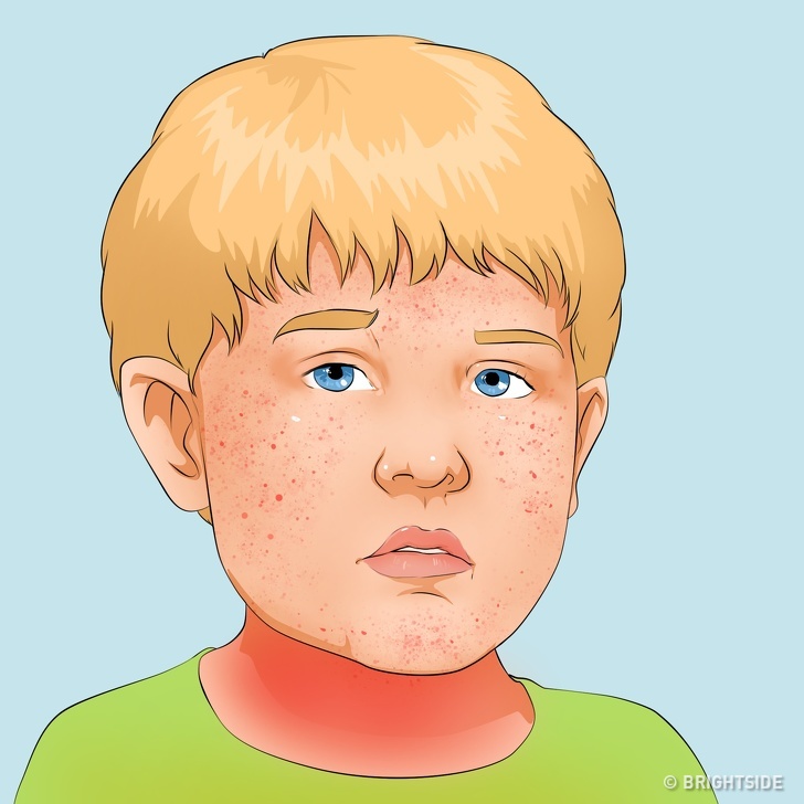 Cách đơn giản nhận biết các bệnh thường gặp ở trẻ em thông qua những dấu hiệu cơ bản  - Ảnh 4