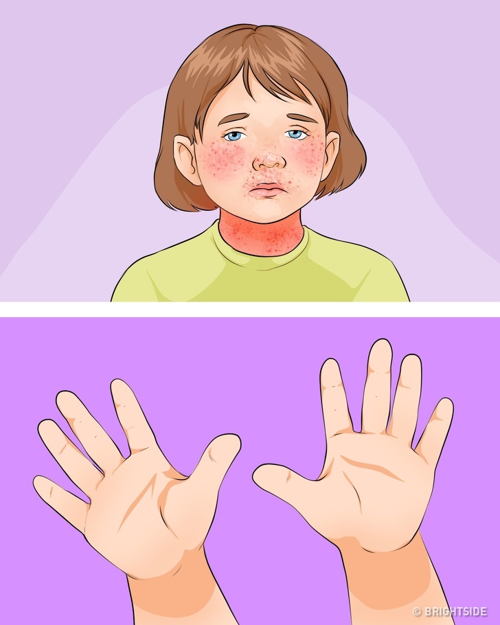 Cách đơn giản nhận biết các bệnh thường gặp ở trẻ em thông qua những dấu hiệu cơ bản  - Ảnh 6