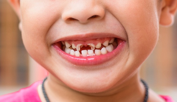 Cách phòng ngừa sâu răng cho trẻ theo lời khuyên của bác sĩ nha khoa - Ảnh 1