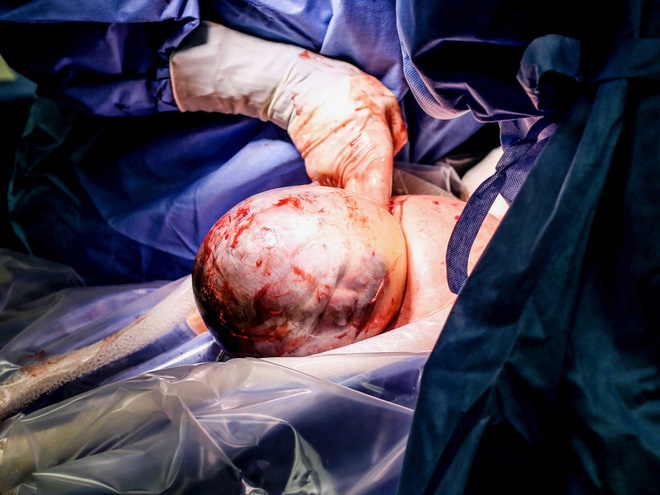 Hiếm thấy trong 80.000 ca sinh: bé gái chào đời với màng ối trùm quanh đầu - Ảnh 2