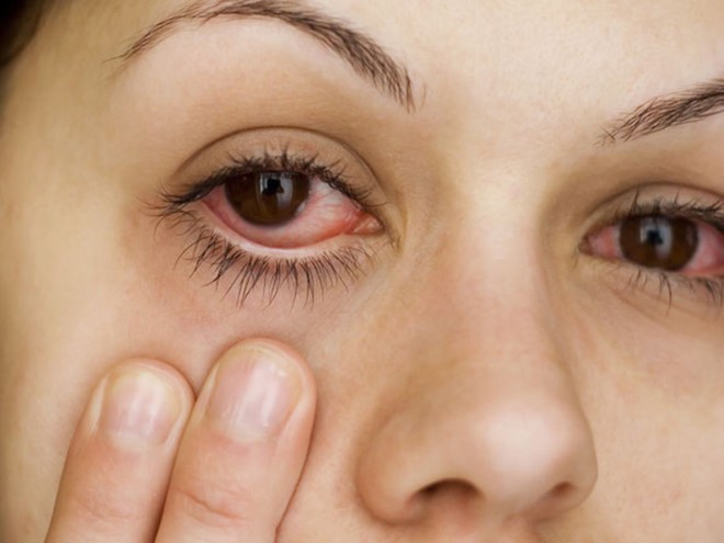 Cách chữa bệnh đau mắt đỏ ở bà bầu an toàn, hiệu quả theo kinh nghiệm dân gian - Ảnh 1