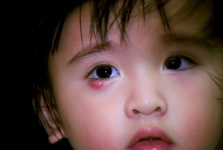 Mẹo dân gian chữa lẹo mắt cho trẻ bằng nguyên liệu có sẵn trong nhà - Ảnh 1