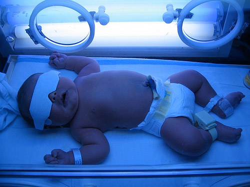Trẻ sơ sinh bị vàng da: Dấu hiệu nhận biết, nguyên nhân và cách điều trị - Ảnh 2