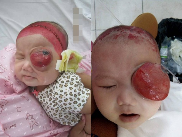 Xót xa bé gái 4 tháng tuổi ung thư hốc mắt, cha mẹ nghèo dốc cạn tài sản chạy chữa cho con - Ảnh 3