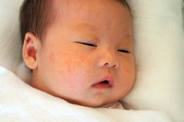 Trẻ sơ sinh nổi mẩn đỏ như muỗi đốt nên chăm sóc như thế nào? - Ảnh 1