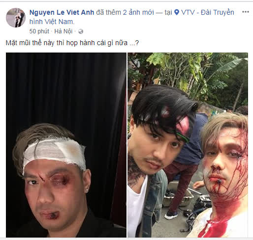 Việt Anh gây sốc khi đăng ảnh mặt mũi bầm dập, ám chỉ mới bị vợ đánh - Ảnh 1