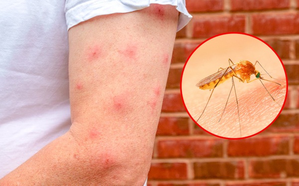 Muỗi chích xâm nhập thẳng vào máu gây nhiễm khuẩn: Bác sĩ chỉ rõ hành động sai ai cũng làm sau khi bị muỗi đốt - Ảnh 1