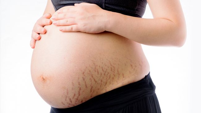 4 dấu hiệu sớm báo bạn chắc chắn sẽ bị rạn bụng khi mang thai - Ảnh 1