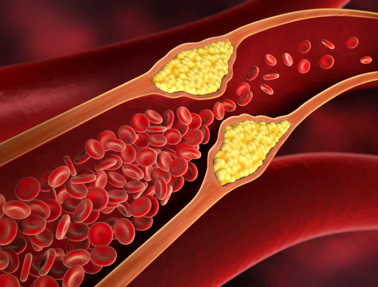 Cholesterol cao: 'Sát thủ' tấn công trực diện sức khỏe vì thói quen 'mở đường' cho mỡ tích tụ mạch máu này - Ảnh 1