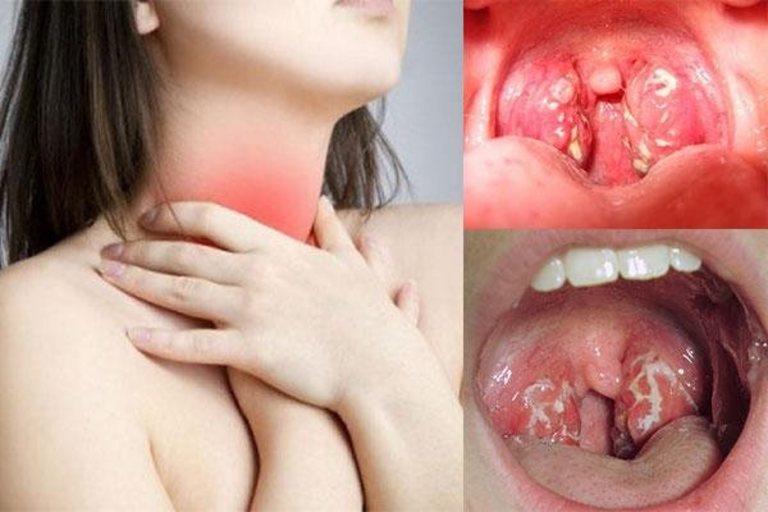 Triệu chứng cảnh báo ung thư vòm họng bạn tuyệt đối không được bỏ qua kẻo có ngày 'trao mạng cho tử thần' - Ảnh 3