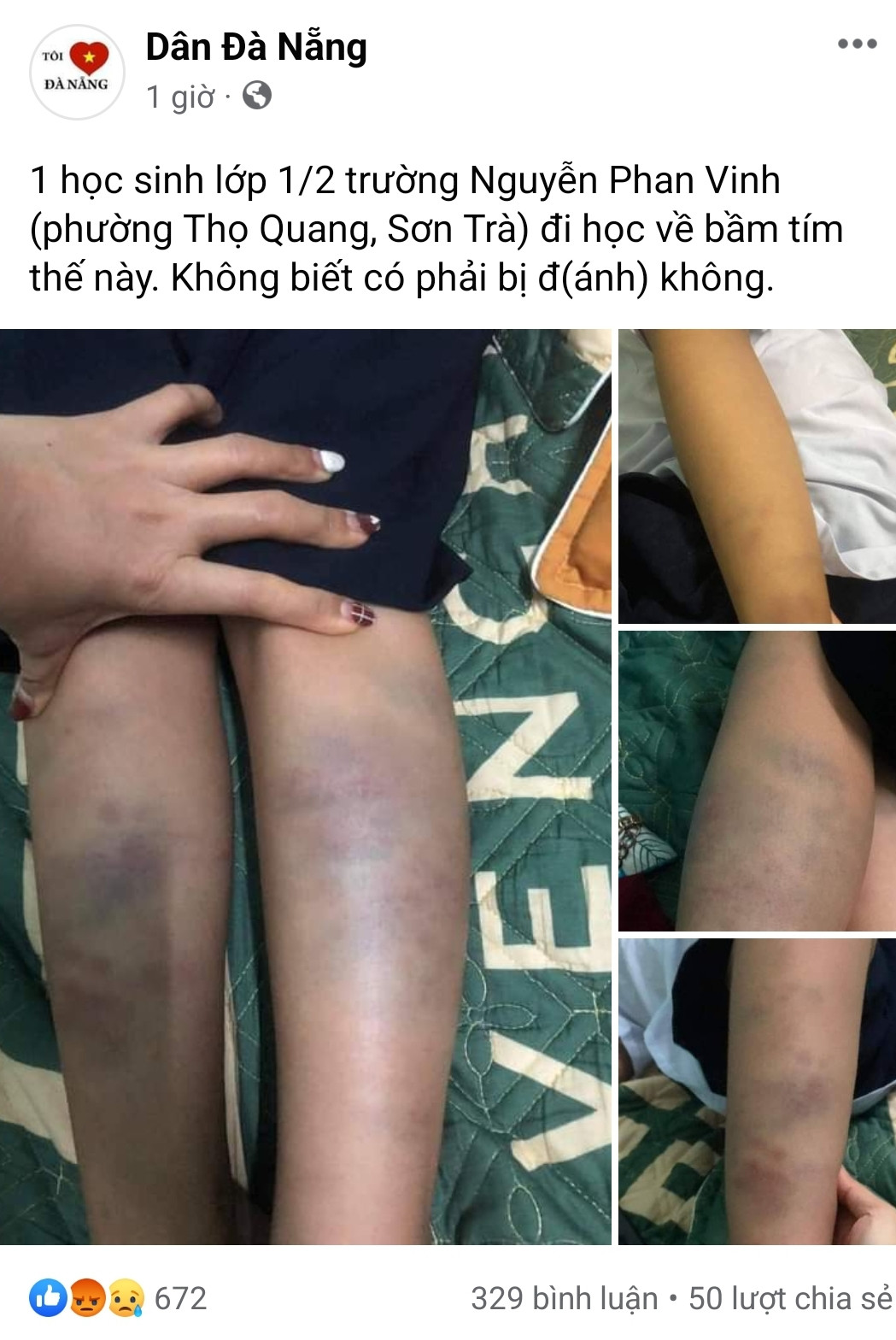 Đà Nẵng: Đón con đi học về, mẹ tá hỏa phát hiện con bị bầm tím tay chân  - Ảnh 1