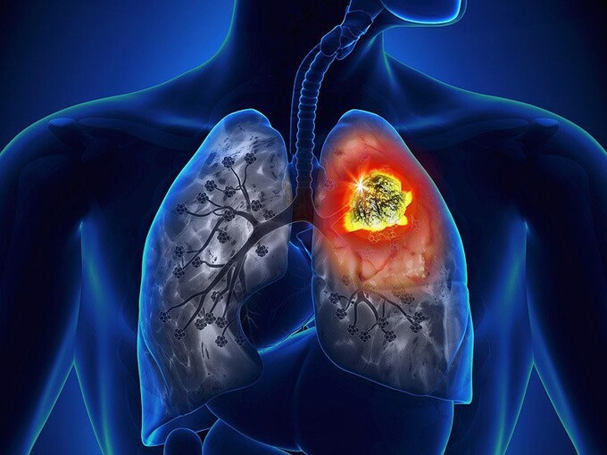 1,8 triệu người tử vong hằng năm do ung thư phổi: 8 dấu hiệu cảnh báo mắc bệnh - Ảnh 1