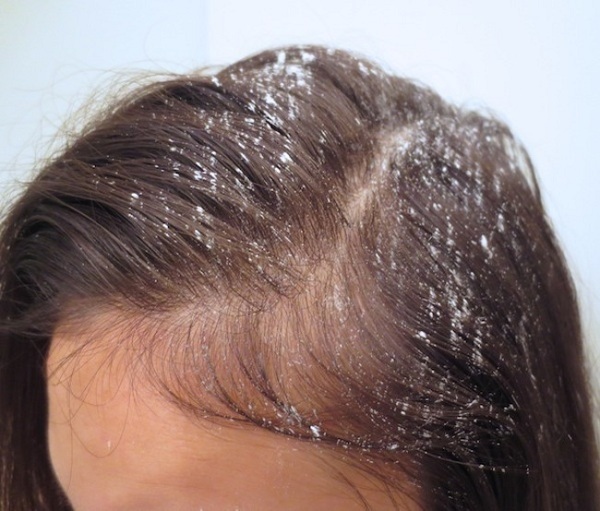Mách bạn 4 cách trị tóc bết hiệu quả tại nhà  - Ảnh 3