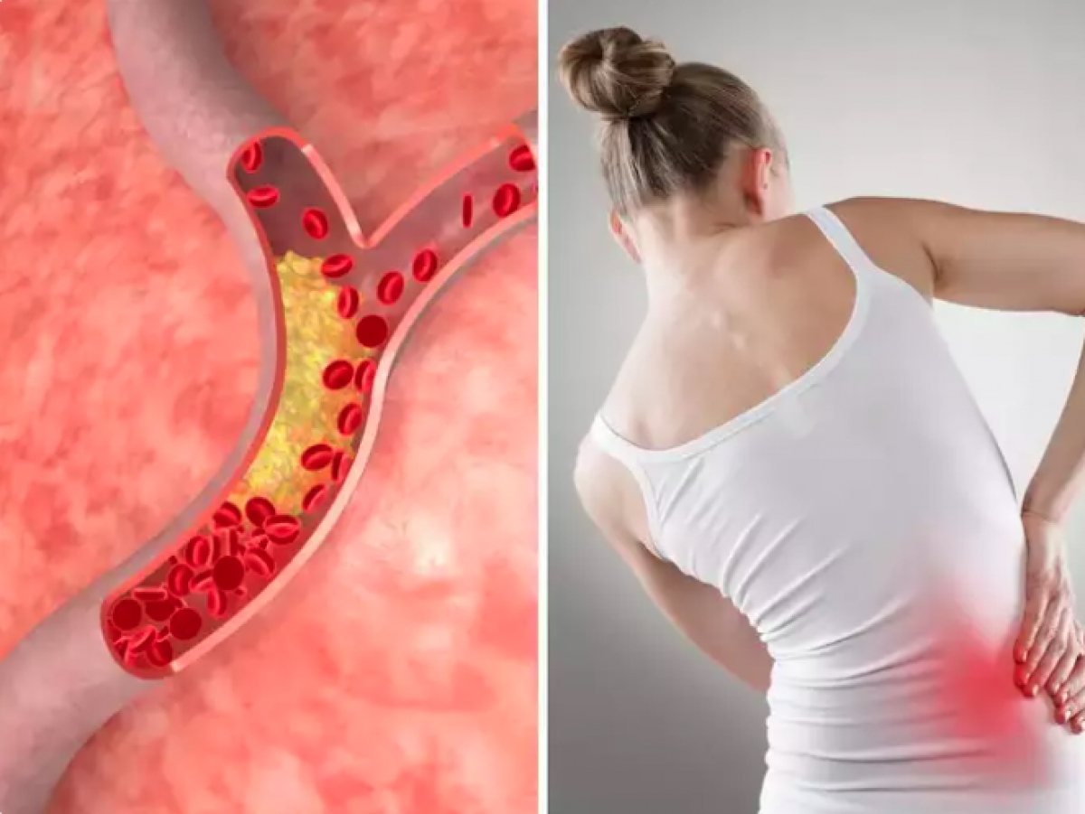 Đau ở hông: Đây là tất cả những gì bạn cần biết về cách cholesterol ảnh hưởng nghiêm trọng đến cơ mông của bạn! - Ảnh 1