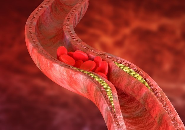 Đau ở hông: Đây là tất cả những gì bạn cần biết về cách cholesterol ảnh hưởng nghiêm trọng đến cơ mông của bạn! - Ảnh 4