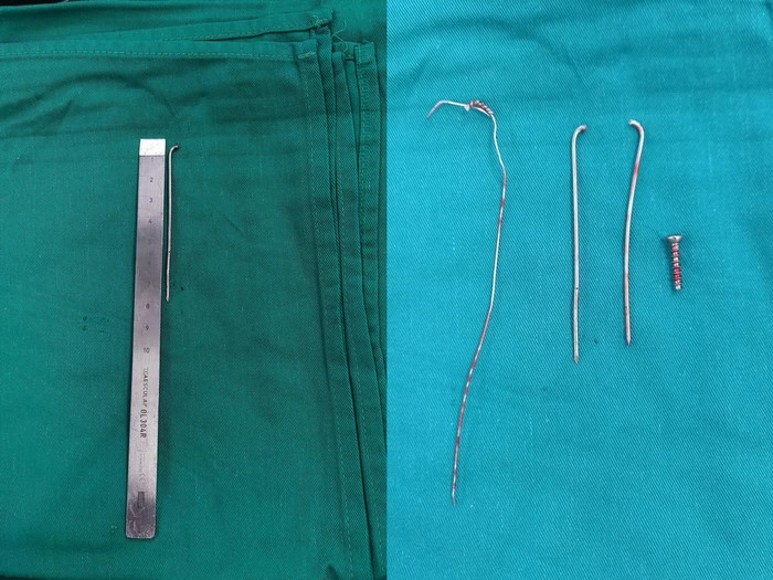 Sau phẫu thuật 3 năm mới đi tái khám, cô gái phát hiện chiếc đinh dài 8cm 'lạc trôi' vào đốt sống cổ - Ảnh 3