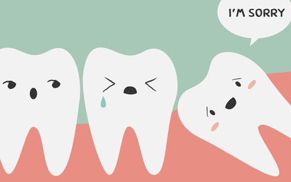 5 biến chứng nguy hiểm khi mọc răng khôn bạn cần biết - Ảnh 2