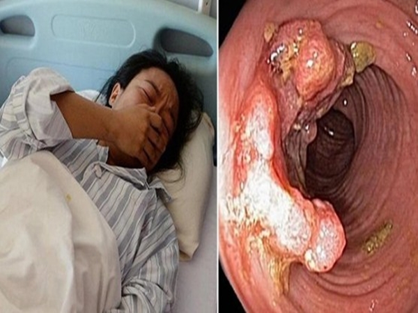 Cô gái 33 tuổi bị ung thư đại trực tràng giai đoạn cuối, nguyên nhân từ một món ai cũng mê - Ảnh 1