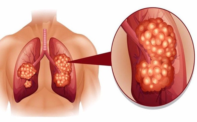 Tưởng cảm cúm thông thường hóa ra lại là dấu hiệu của bệnh ung thư phổi - Ảnh 1