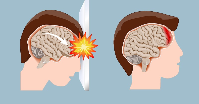 3 triệu chứng đau đầu khi ngủ cảnh báo xuất huyết não: cần chuyển viện cấp cứu ngay   - Ảnh 1