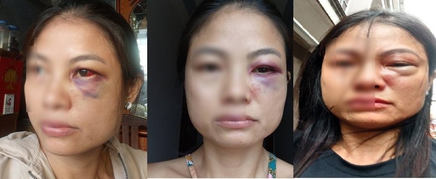 Xót xa câu nói của người vợ bị chồng đánh đến mức nhập viện ở Đồng Nai: 'Có tuần bị đánh tới 3 lần' - Ảnh 1