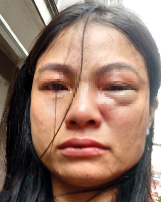 Xót xa câu nói của người vợ bị chồng đánh đến mức nhập viện ở Đồng Nai: 'Có tuần bị đánh tới 3 lần' - Ảnh 2