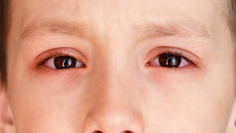 Lý giải về triệu chứng đau mắt đỏ do COVID-19 - Ảnh 1