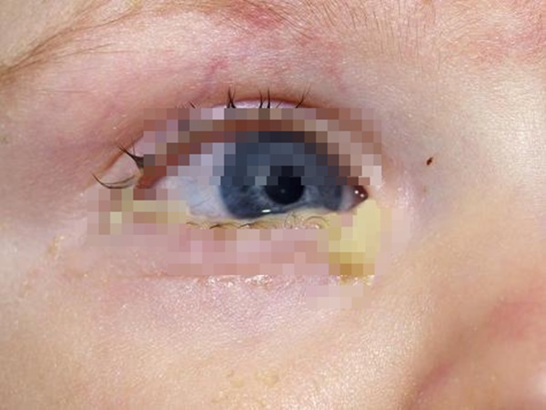 Lý giải về triệu chứng đau mắt đỏ do COVID-19 - Ảnh 2