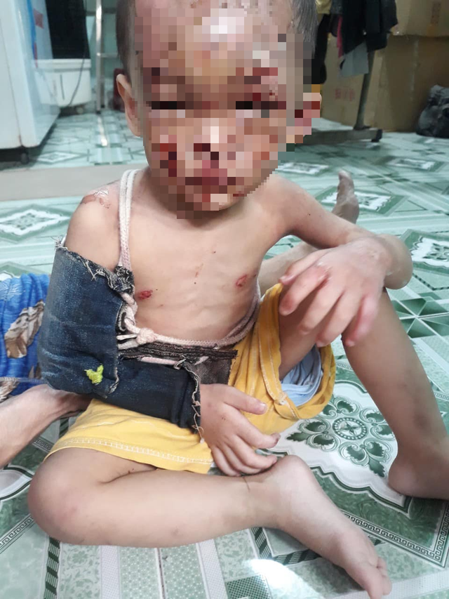 Đau lòng bé trai 2 tuổi bị bố mẹ bạo hành: 'Ở chỗ nào cũng bị thương, bị bỏng! Không thể bỏ cháu được' - Ảnh 4