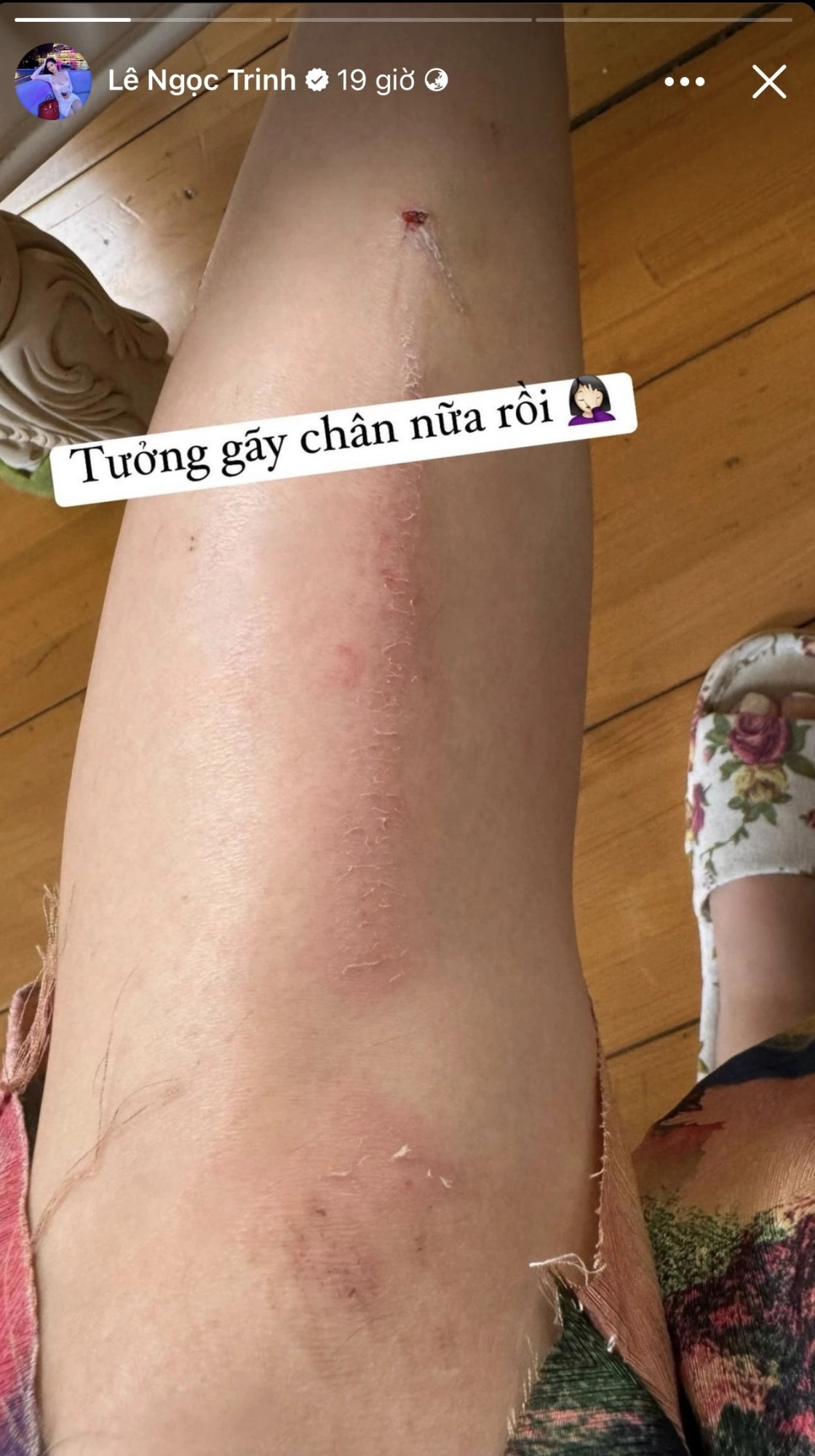 'Bản sao' Ngọc Trinh gặp tai nạn suýt gãy chân, được bạn trai mới làm một việc khiến netizen ngưỡng mộ - Ảnh 2