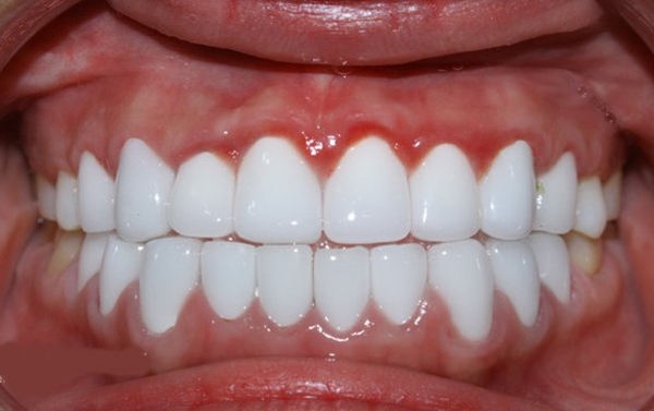 Nhai 1 nắm lạc sống trong 3 phút, cao răng cả năm không đi lấy cũng được 'cạo sạch' trắng sáng hơn cả đi tẩy ở nha khoa - Ảnh 4