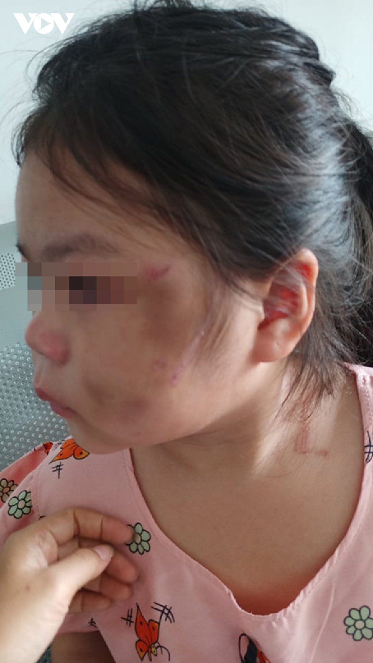 Bình Dương: Bé gái 6 tuổi bầm tím mặt vì cha ruột “lỡ tay' và lý do không ai ngờ đến - Ảnh 1